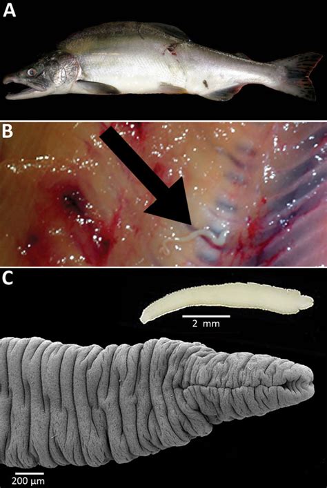 Fish Tapeworm Infection (Diphyllobothri.